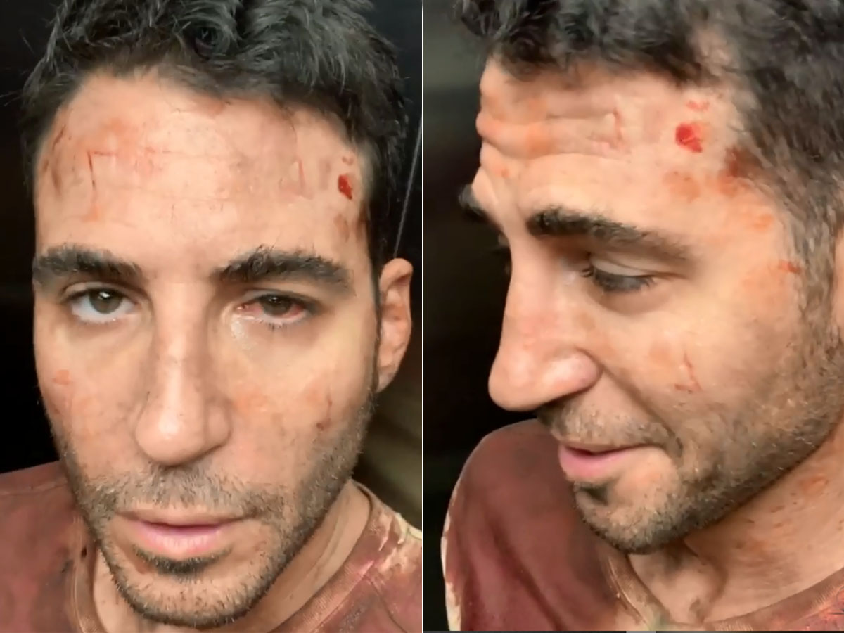 ¿Qué le ha pasado a Miguel Ángel Silvestre en la cara? ¿Un accidente?